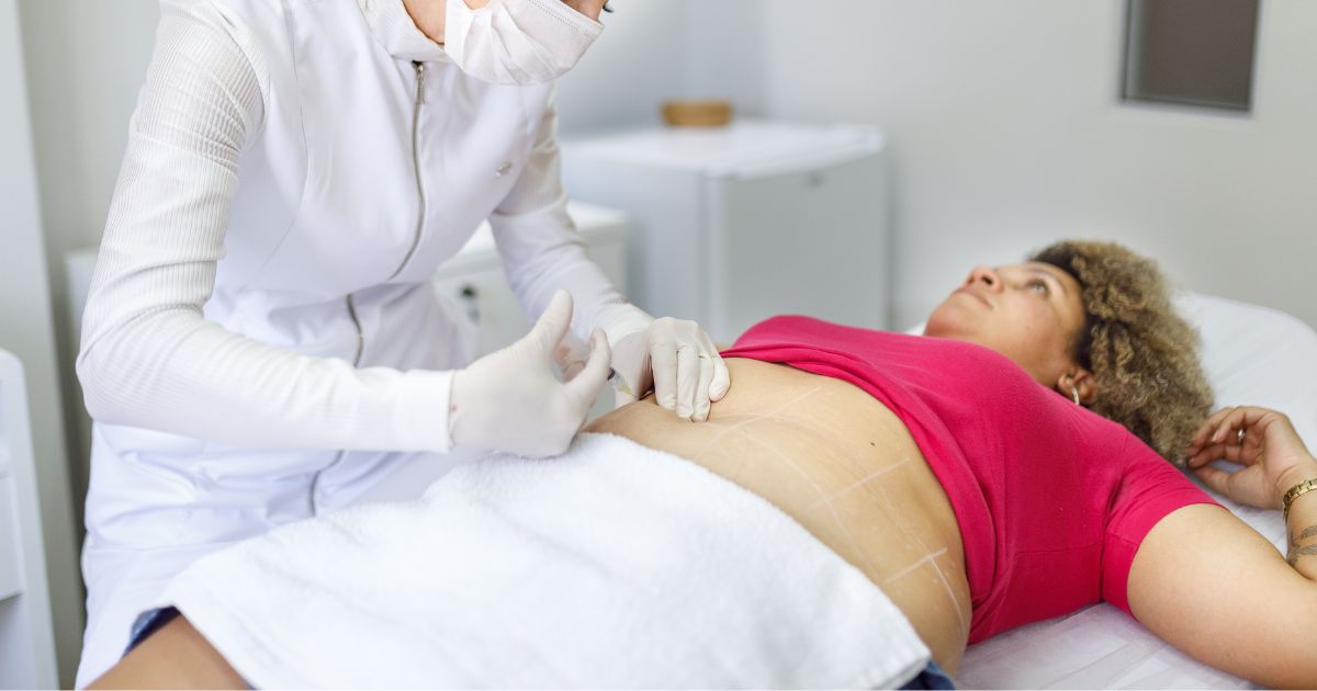 intradermoterapia-para-gordura-localizada